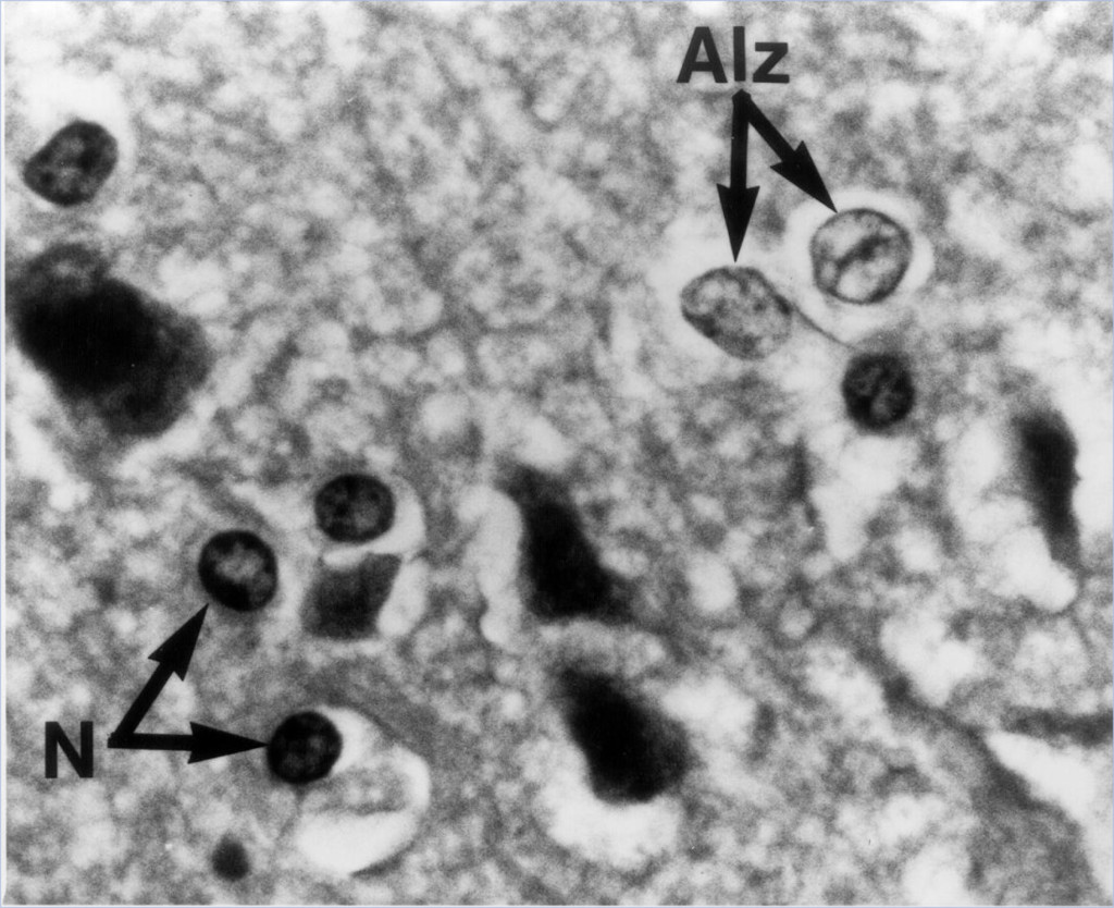 1680_Neuropathological_changes2